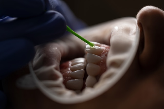 Zahnbleaching für weißere Zähne