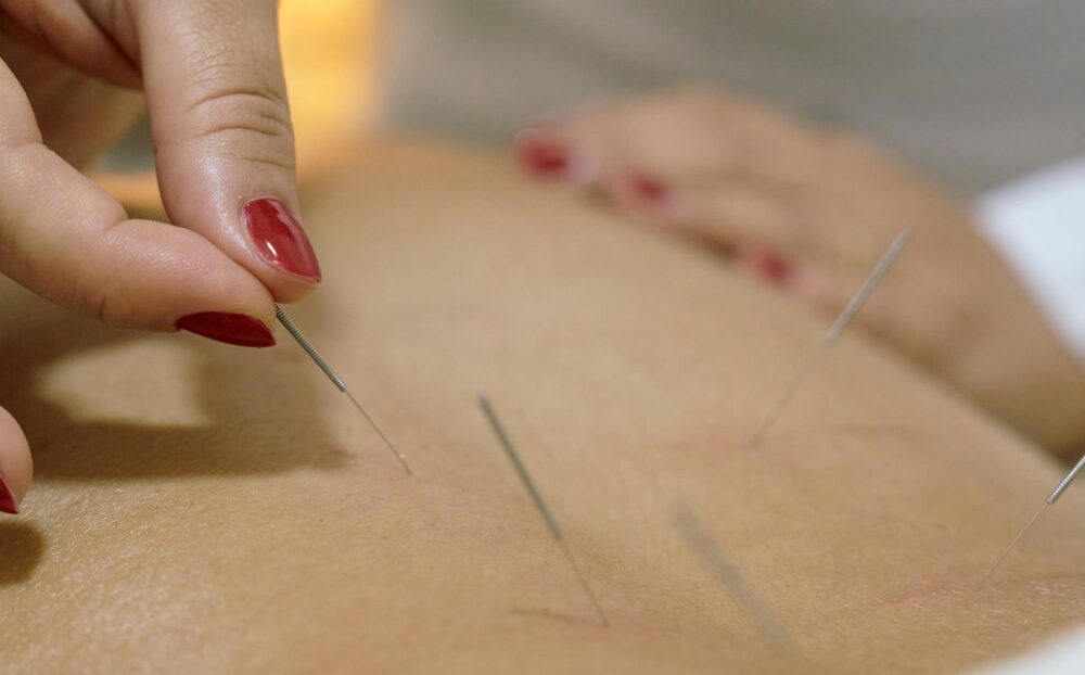 Akupunktur bei Bandscheibenvorfall - wie gut funktioniert das ...