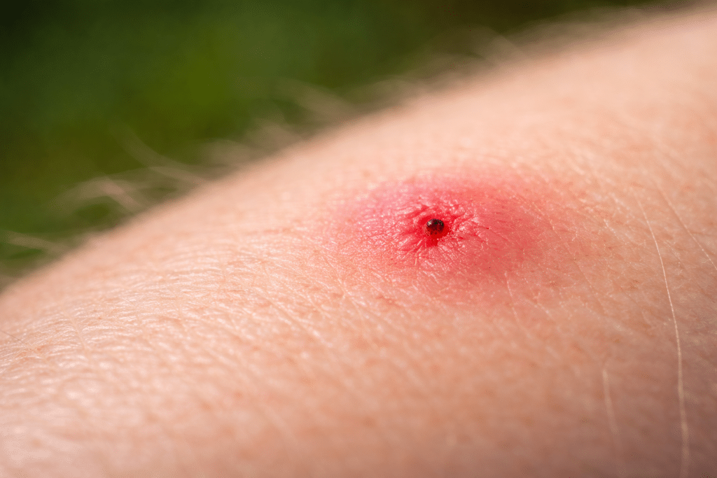 Biss der Kriebelmücke erkennen und richtig handeln